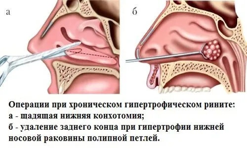 Хронічний гіпертрофічний риніт: причини, симптоми, ознаки, лікування... хронічний гіпертрофічний нежить