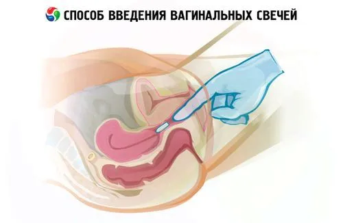 свічки від гарднереллеза