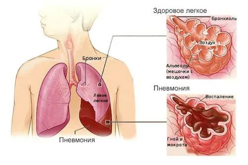 запалення легені діти симптоми немовлята лікування новонароджені