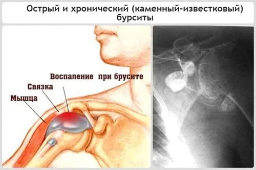 Бурсит плечового суглоба: симптоми, причини, лікування, відновлення... як лікувати бурсит лопатки