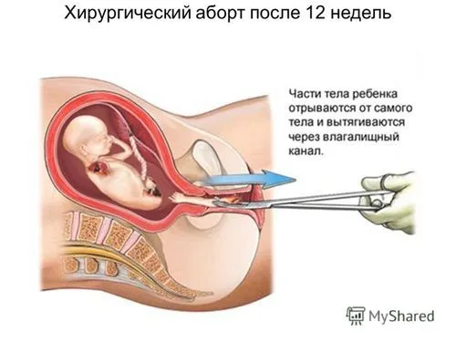 Безпліддя після аборту - ймовірність, ризики, лікування безпліддя після аборту аборт і ймовірність безпліддя медикаментозний медикаментозного