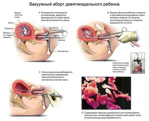 Безпліддя після аборту - ймовірність, ризики, лікування як вилікувати безпліддя після аборту