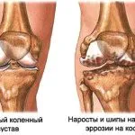 як лікувати меніск в домашніх умовах