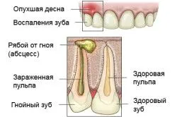 Як лікувати нарив на яснах як лікувати нарив ясен