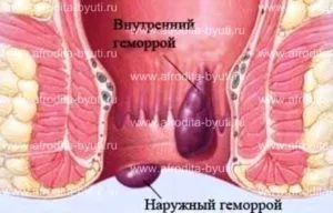 як лікувати геморой ромашкою