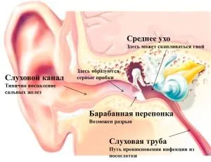 як лікувати гострий гнійний отит