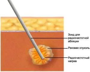 як лікувати рак будинку