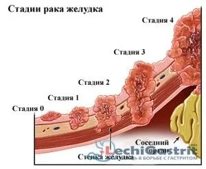 як лікувати аденокарциному шлунка