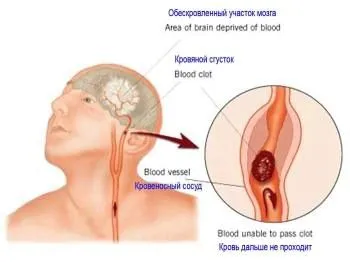 як лікувати інсульт будинку
