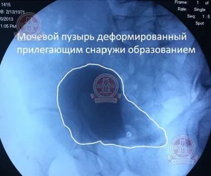 як лікувати кісту малого таза