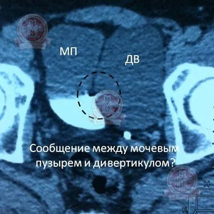 як лікувати кісту малого таза