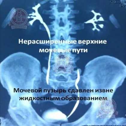 як лікувати кісту малого таза