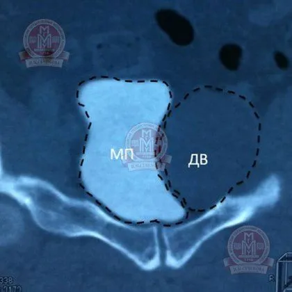 як лікувати кісту малого таза
