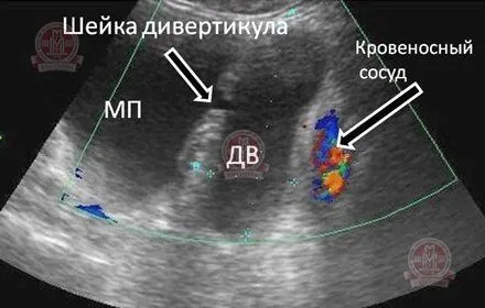 як лікувати кісту малого таза