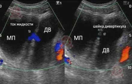 як лікувати кісту малого таза