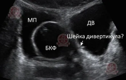 як лікувати кісту малого таза
