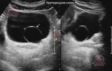 як лікувати кісту малого таза