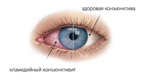 як лікувати хламідіоз у жінок препарати