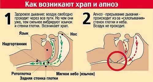 як лікувати хропіння у чоловіків