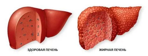 як лікувати гепатоз печінки в домашніх умовах