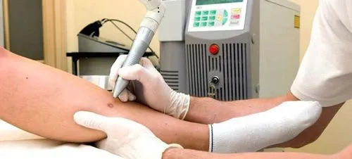 як вилікувати папіломи на тілі