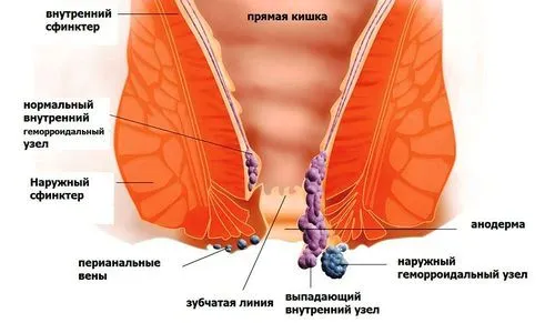 лікувати зовнішній геморой