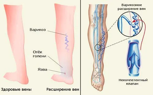 як лікувати варикоз ліками