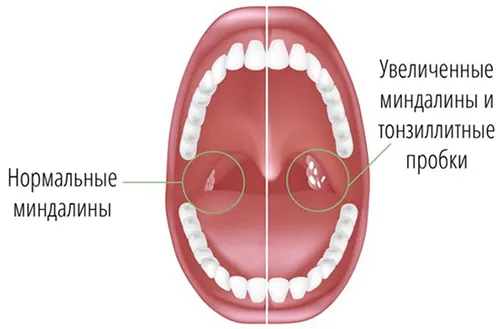 як лікувати мигдалини пробки
