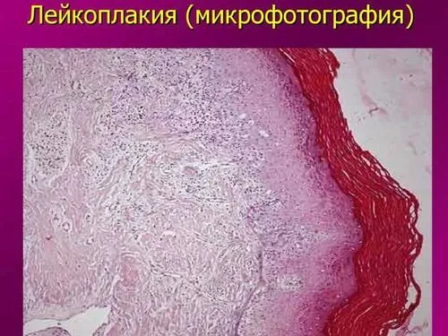 як лікувати лейкоплакію мови
