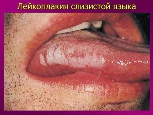 як лікувати лейкоплакію мови