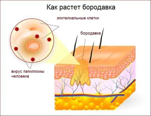 як вилікувати бородавки на тілі