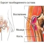 як лікувати вертельную бурсит