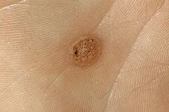 як вилікувати бородавки під грудьми
