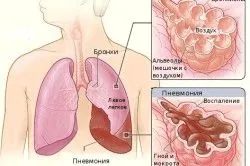 як лікувати правостороннім пневмонію