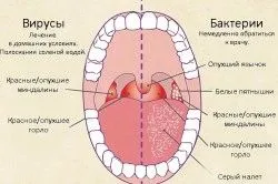лікувати фарингіт дорослих