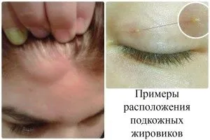 народний засіб від жировик на тіло особа голова