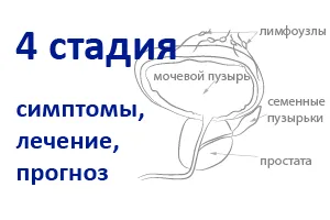 як лікувати рак простати 4 стадії
