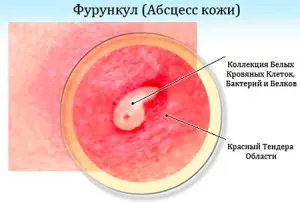 лікувати фурункул народними засобами