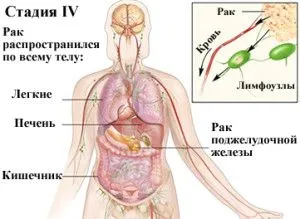як вилікувати рак 4 ступеня
