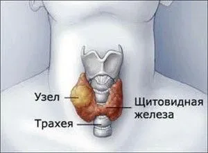 як вилікувати зоб в домашніх умовах