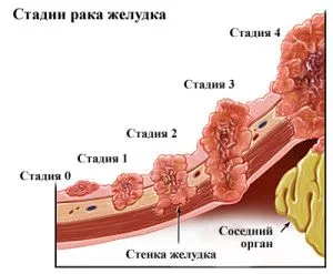 Рак шлунка 3 ступеня: прогноз, симптоми і лікування як лікувати рак шлунка 3 ступеня