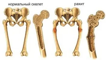 Рахіт, симптоми і лікування рахіту як лікувати рахіт у дорослих