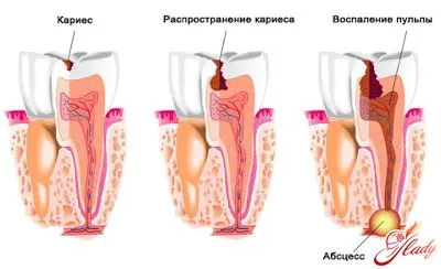 вилікувати карієс сіллю