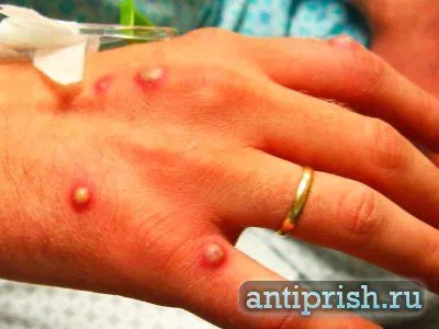 як вилікувати прищі за допомогою алое
