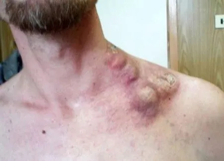рак лімфовузли лімфома причини симптоми прогноз наслідки фото ознаки болять запалення скільки живуть збільшені відео