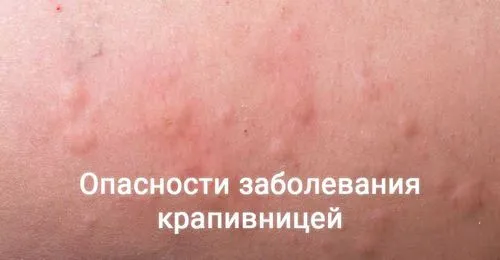 як лікувати алкогольну кропив'янку