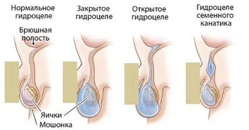 варикоз нижніх кінцівок симптоми лікування