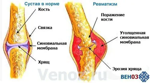 ревматизм симптоми суглобів що це таке серця як лікувати лікування дітей сімейний рецепт ознаки препарати ніг