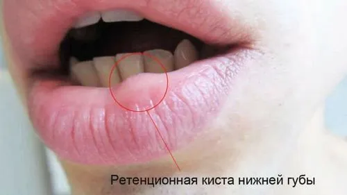 як лікувати кісту губи