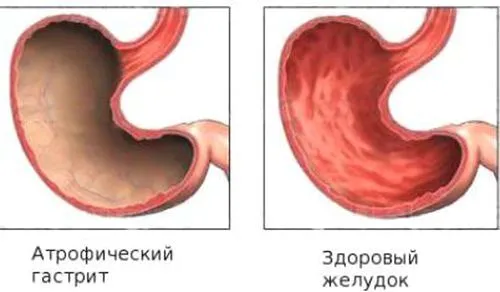 як лікувати бородавчастий гастрит